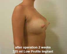 plastic-surgery-breast-augmentation